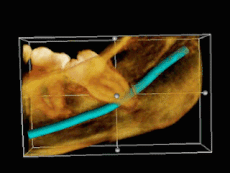 3D CT impacted wisdom tooth.Gif