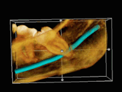 3D CT لضرس العقل المنطمر المتاخم للعصب السنخي السفلي قبل خلعه