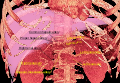 Tomografie computerizată redată 3D, care arată o venă renală (în culoare roșie) pentru fiecare rinichi