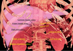 3D-gerenderde CT van abdominale aorta takken en nieren.svg