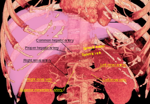 3D rendered CT of abdominal aortic branches and kidneys.svg