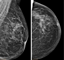 Arteriolosclerosis mammography.png