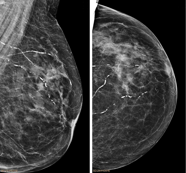 Маммография молочных желез 4. Рик молочной железы маммографич. Маммография рентген молочной железы. Мастит молочной железы на маммографии. Хронический мастит маммография.