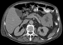 CT scan in a patient with acinar cell carcinoma Azinuszellkarzinom des Pankreasschwanz - CT axial 001.jpg
