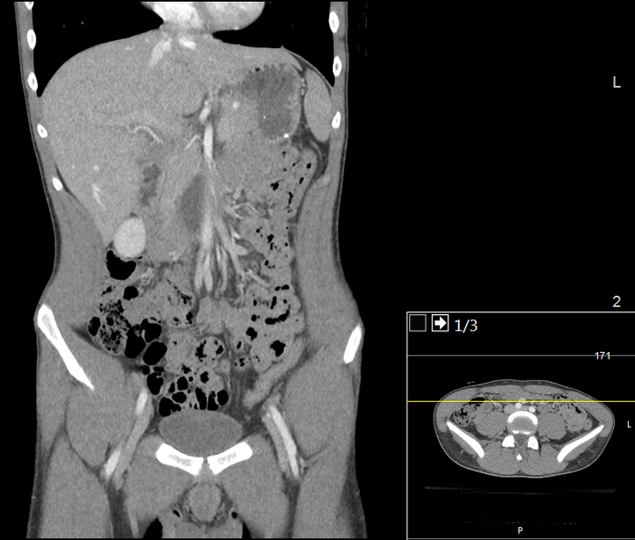 CT of a normal abdomen and pelvis, coronal plane 50.png