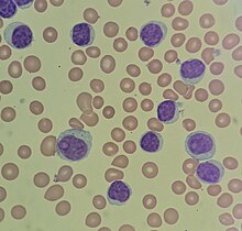 Chronic lymphocytic leukemia with prolymphocytes.jpg