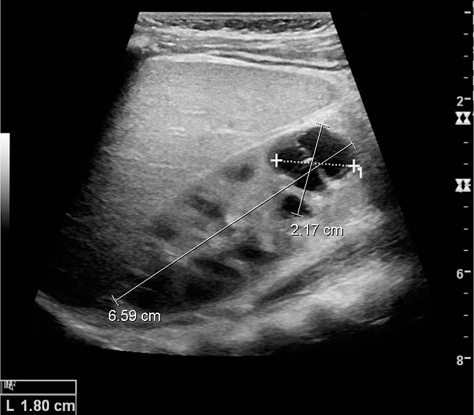 File:Complex cyst with thickened walls and membranes in the lower pole.jpg