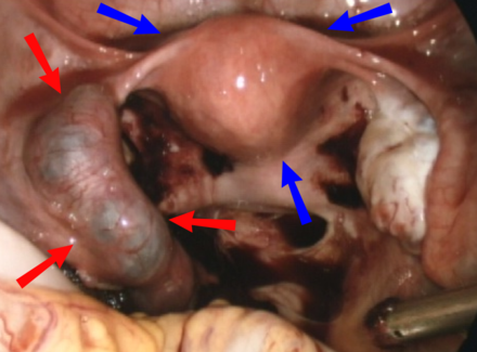 Laparoscopic view of ectopic pregnancy