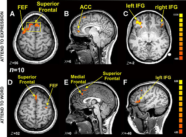 Activació neuronal en una tasca emocional.