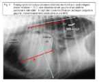 Fig. 9 : Radiographie thoracique (incidence latérale) montrant une cardiomégalie (index vertébral = 13,1), une dilatation atriale gauche et un œdème pulmonaire interstitiel : il s’agit bien d’une insuffisance cardiaque congestive gauche, vraisemblablement consécutive à une MVD.