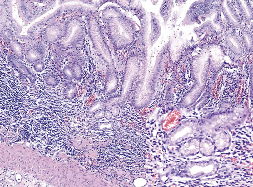 Histopathology of fundic mucosa with atrophy. H&E 10x; square 20x. Fundic-corporal gastric mucosa with extensive loss of gastric glands, partially replaced by pseudo-pyloric metaplasia.