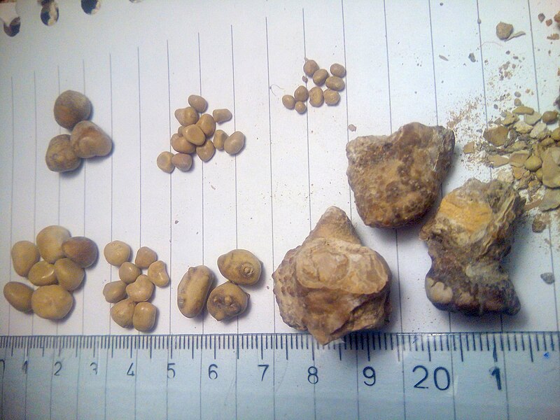 kidney stone (wikimedia Commons)