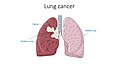 Lung cancer - Healthy lung Smokers lung with cancer