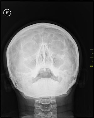 Medical X-Ray imaging XDT07 nevit.jpg