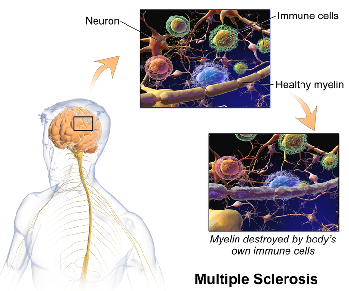 File:Multiple Sclerosis.png