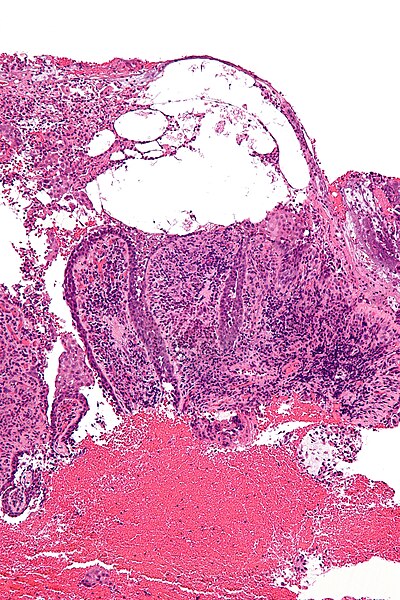 File:Pemphigus vulgaris - intermed mag.jpg