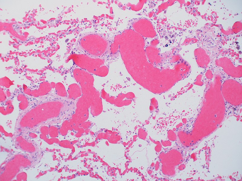 File:Pulmonary capillary hemangiomatosis (4348914786).jpg