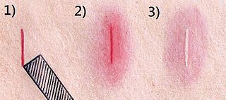 <span class="mw-page-title-main">Triple response of Lewis</span> Cutaneous response from firm stroking of skin