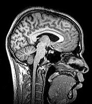 Sagittal brain MRI.jpg
