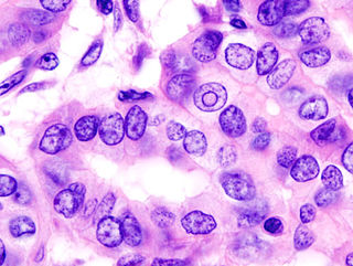 <span class="mw-page-title-main">Thyroid cancer</span> Medical condition
