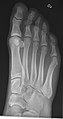 X-ray of normal right foot by oblique projection.jpg