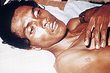 A person with severe dehydration due to cholera PHIL 1939 lores.jpg