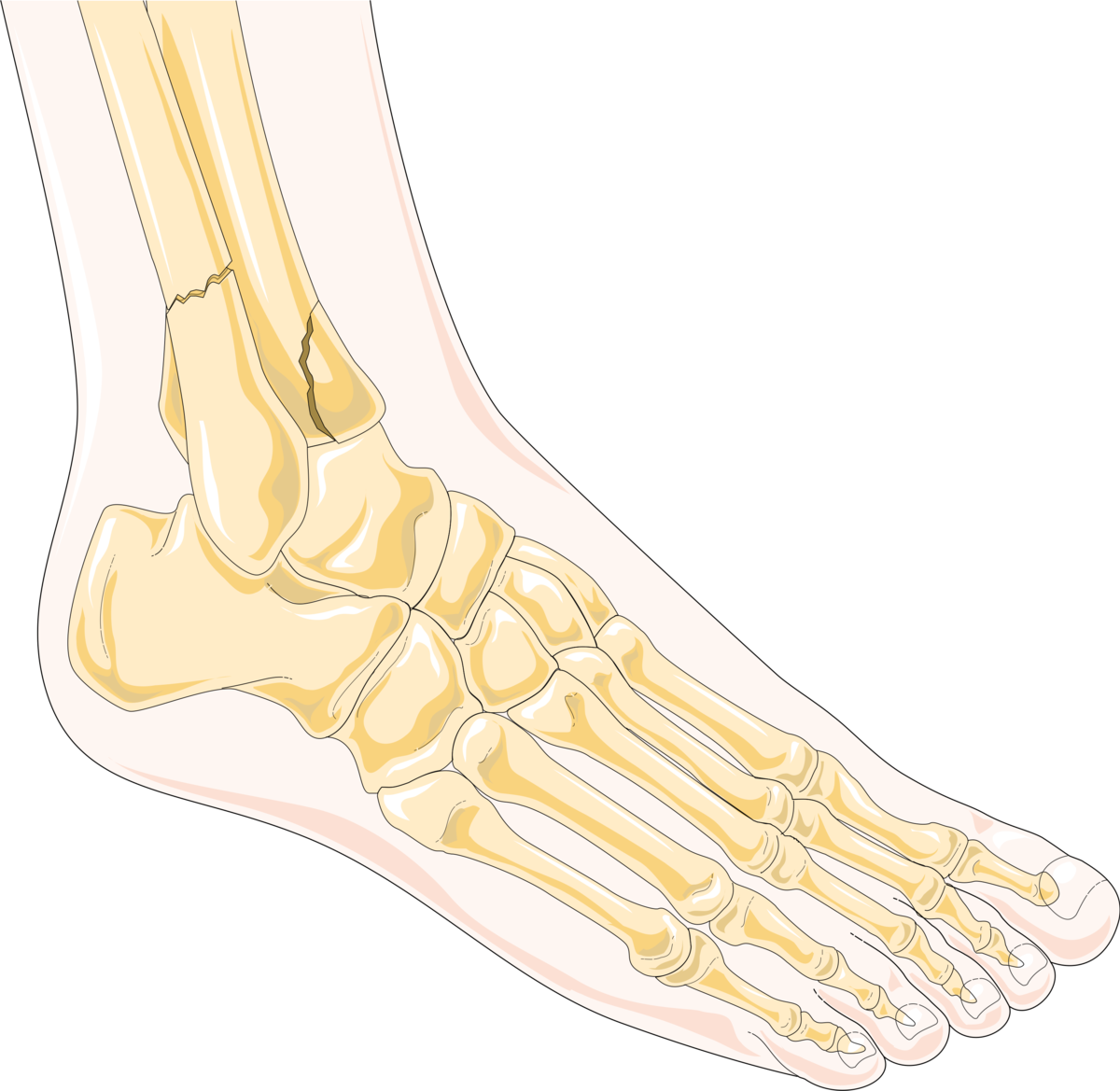 Fracture de la cheville — Wikipédia