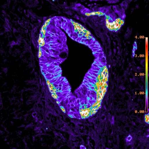 File:Breast cancer cells.tif