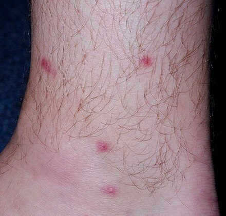 Foot Itch - Symptoms, Causes, Treatments - Healthgrades.com