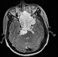 September 2: MRI scan of a patient with chordoma.