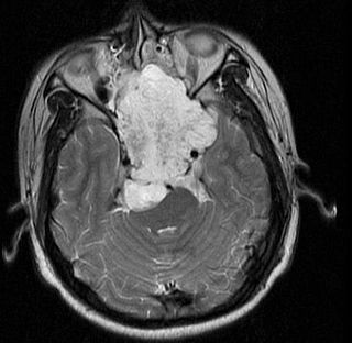 Chordoma Type of spinal cancer