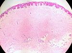 Thumbnail for Cutaneous leiomyoma