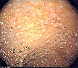 <span class="mw-page-title-main">Familial adenomatous polyposis</span> Medical condition