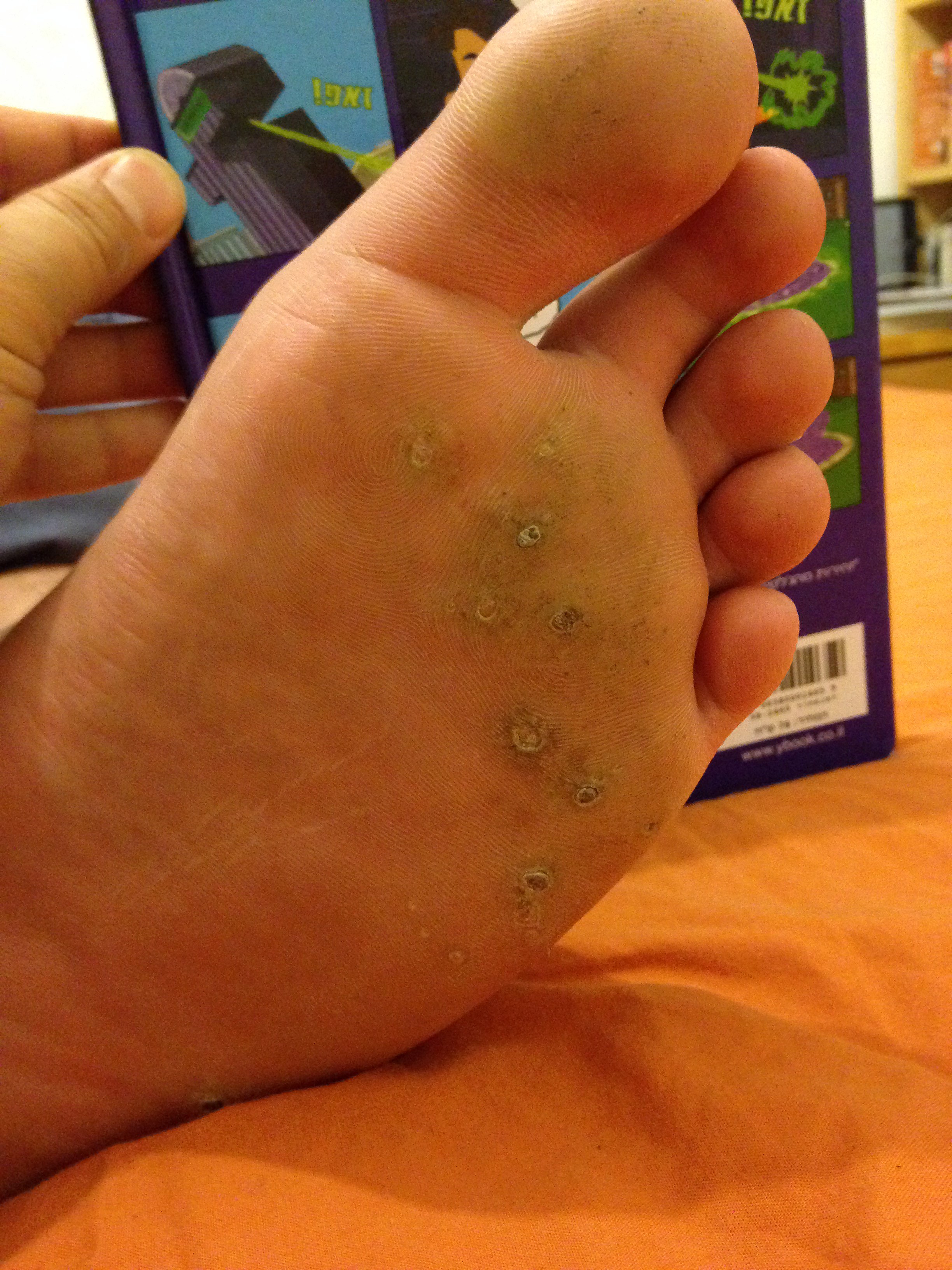 Papilloma in foot. Papilloma foot removal