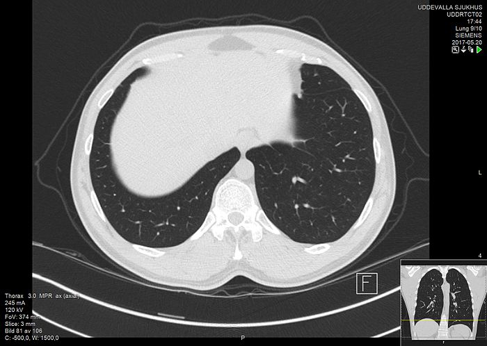 High-resolution computed tomograph of a normal thorax, axial plane (83).jpg