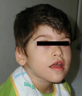 Pitt–Hopkins syndrome