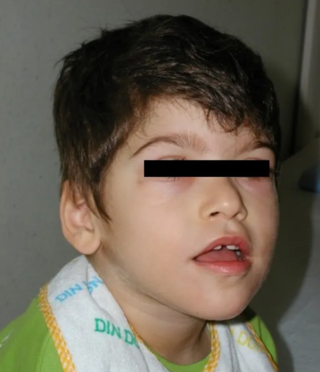 <span class="mw-page-title-main">Pitt–Hopkins syndrome</span> Medical condition