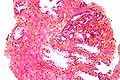 Frustolo bioptico, alto ingrandimento, colorazione cromo-ematossilina-floxina che evidenzia ghiandole normali (in basso e a sinistra) e ghiandole neoplastiche (in alto a destra). Si noti come le ghiandole neoplastiche siano più piccole e stipate e presentino grandi nuclei amorfi.