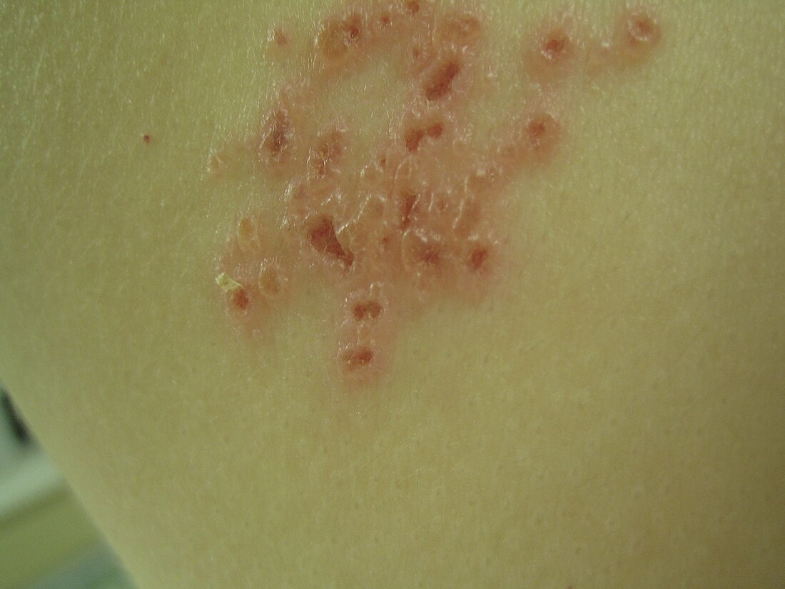 Vescicola (dermatologia)