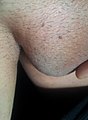 Small condylomata on scrotum