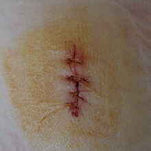 Wound, sewn with four stitches Wound sewed.jpg