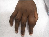 An irregularly-thickened first finger; proximal fingerbone is asymmetrically swollen
