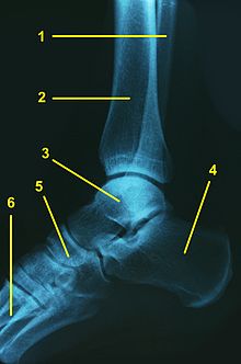 leziuni acute ale gleznei tratamentul articulațiilor genunchiului artroza sau artrita