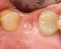 Identifikuje se oblast úst, kde chybí zub.
