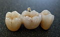Protesi dentaria in materiale ceramico