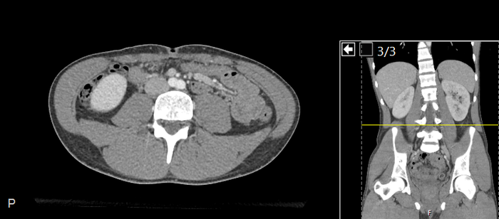 CT of a normal abdomen and pelvis, axial plane 150.png