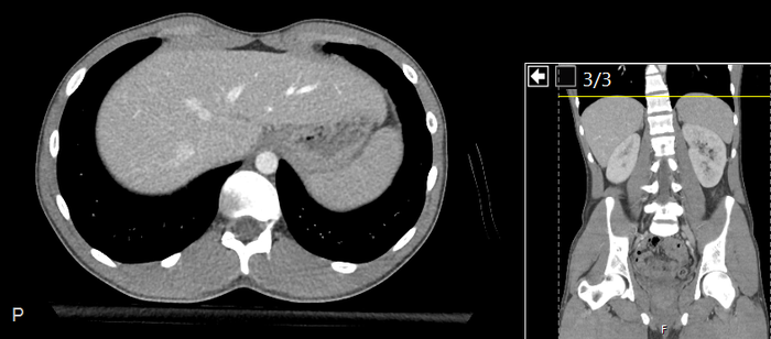 CT of a normal abdomen and pelvis, axial plane 38.png