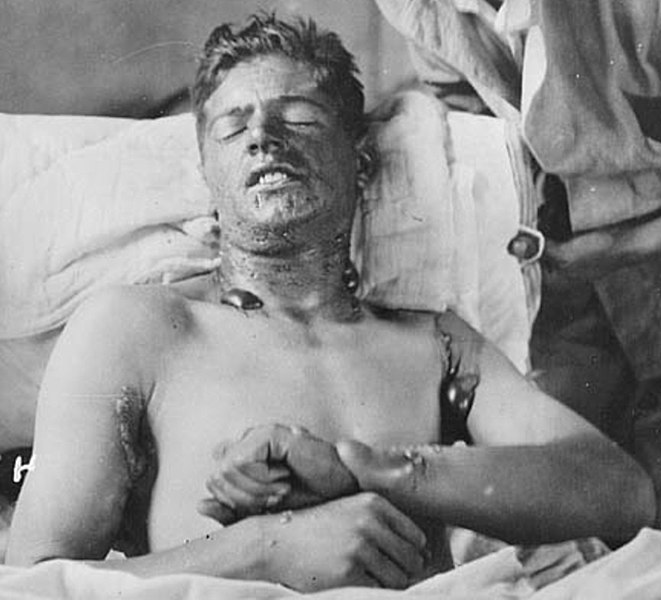 File:Canadian Soldier with mustard gas burns (cropped).jpg