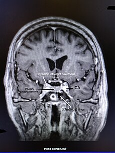 T1-weighted post contrast coronal section of non-functioning pituitary adenoma. The tumor is seen extending into the right cavernous sinus. Coronal section of non-functioning pituitary adenoma.jpg