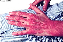 Dermatomyositis16.jpg